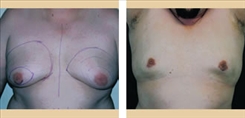 Gynecomastia Patient Before & After Photo 1