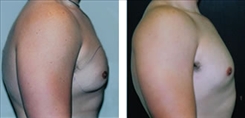 Gynecomastia Patient Before & After Photo 1