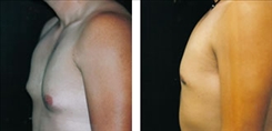 Gynecomastia Patient Before & After Photo 1