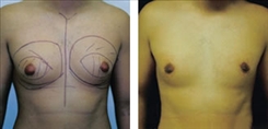 Procedures for Men Patient Before & After Photo 1