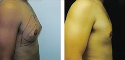 Gynecomastia Patient Before & After Photo 1