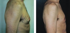 Procedures for Men Patient Before & After Photo 1