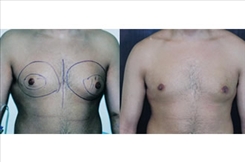 Gynecomastia Patient Before & After Photo 1