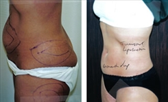 Liposuction Patient Before & After Photo 1