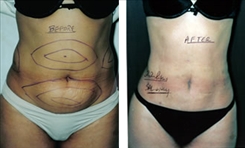 Liposuction Patient Before & After Photo 1