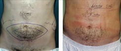 Liposuction Patient Before & After Photo 1