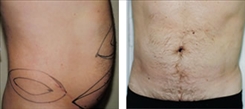 Liposuction Patient Before & After Photo 1