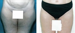 Liposuction Patient Before & After Photo 1