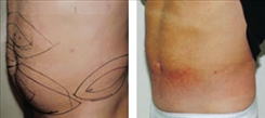 Liposuction Patient Before & After Photo 1