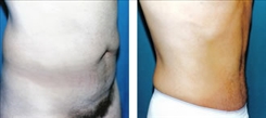 Liposuction Patient Before & After Photo 1