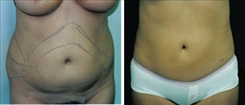 Liposuction Patient Before & After Photo 1