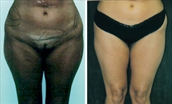 Liposuction Patient Before & After Photo 1