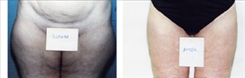 Liposuction Patient Before & After Photo 1