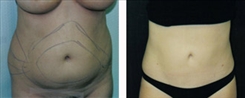 Liposuction Patient Before & After Photo 1