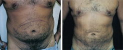 Liposuction Patient Before & After Photo 1