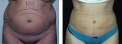 Liposuction Patient Before & After Photo 1