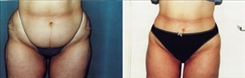 Liposuction Patient Before & After Photo 1