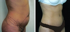 Liposuction Patient Before & After Photo 1