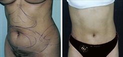 Liposuction Patient Before & After Photo 1