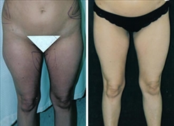 Liposuction Patient Before & After Photo 1