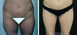 Liposuction Patient Before & After Photo 1