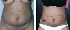 Liposuction Patient Before & After Photo 1