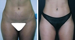 Liposuction Patient Before & After Photo 1