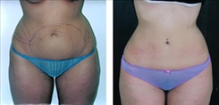 Liposuction Patient Before & After Photo 1