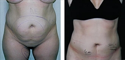 Liposuction Patient Before & After Photo 1