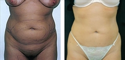 Liposuction Patient Before & After Photo 1