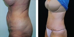 Liposuction Patient Before & After Photo 1