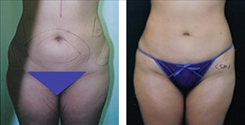 Liposuction Patient Before & After Photo 1