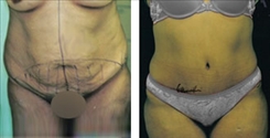 Liposuction Patient Before & After Photo 1