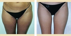 Liposuction Patient Before & After Photo 1