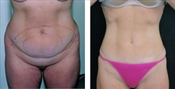 Liposuction Patient Before & After Photo 1