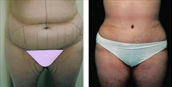 Liposuction Patient Before & After Photo 1