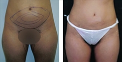 Liposuction Patient Before & After Photo 1