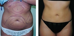 Liposuction Patient Before & After Photo 1