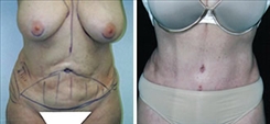 Liposuction Patient Before & After Photo 1