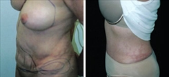 Liposuction Patient Before & After Photo 1