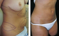 Liposuction Patient Before & After Photo 1