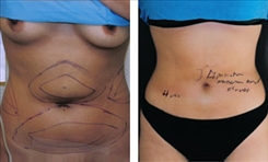 Liposuction Patient Before & After Photo 1