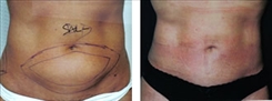 Liposuction Patient Before & After Photo 1