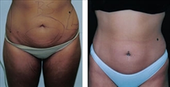 Liposuction Patient Before & After Photo 1