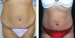 Liposuction Patient Before & After Photo 1