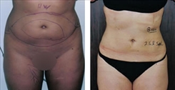 Liposuction Patient Before & After Photo 1