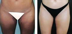 Liposuction Patient Before & After Photo 1