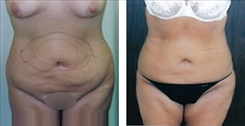 Liposuction Patient Before & After Photo 1