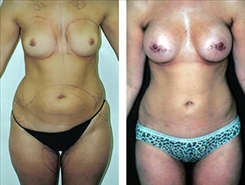 Liposuction Patient Before & After Photo 1