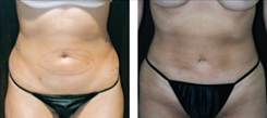 Liposuction Patient Before & After Photo 1